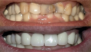 COMPOSITE RESTORATION A complete teeth makeover: quick, painless and convenient